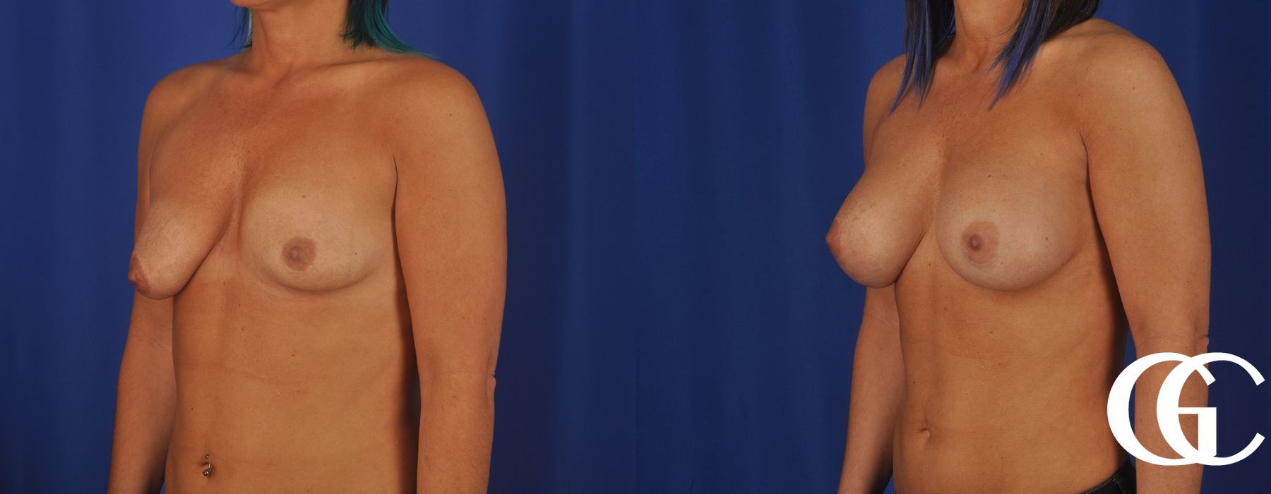 Breast Lift - Thumbnail 5