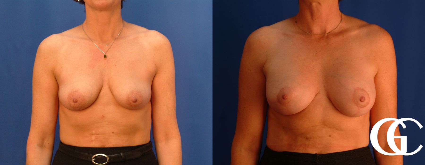 Breast Lift - Thumbnail 2