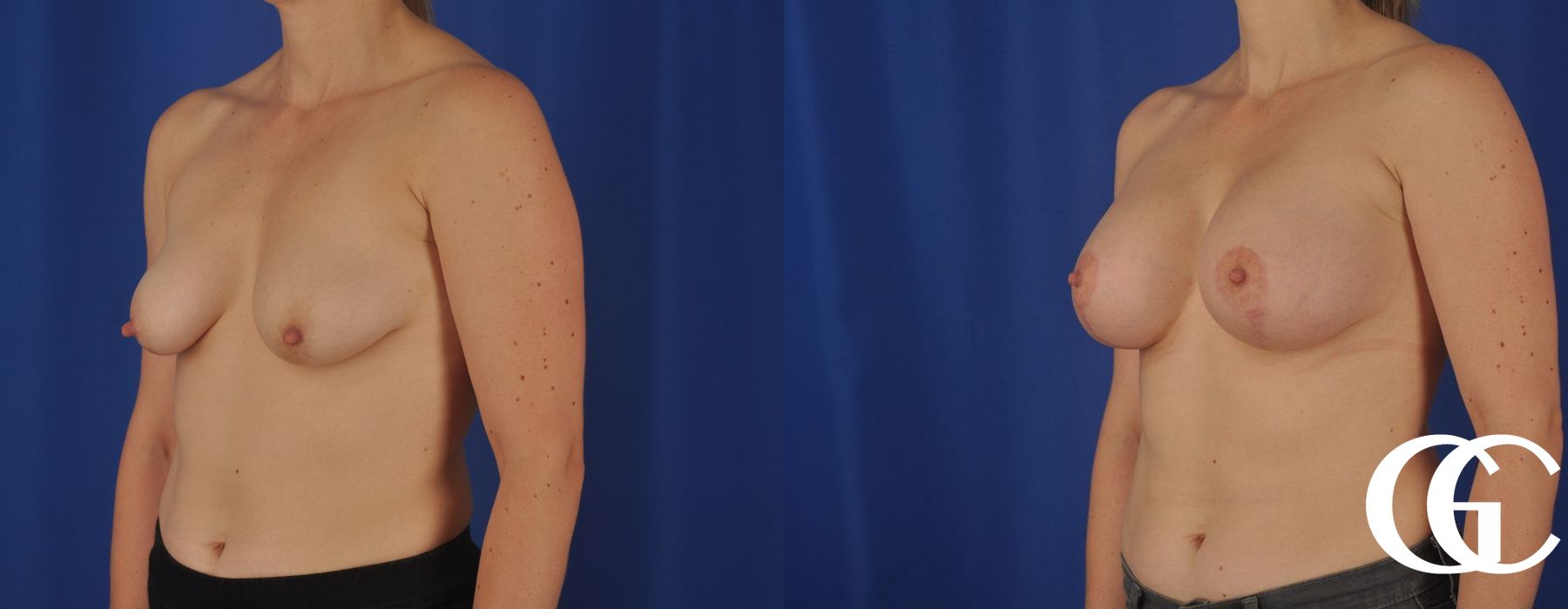 Breast Lift - Thumbnail 2