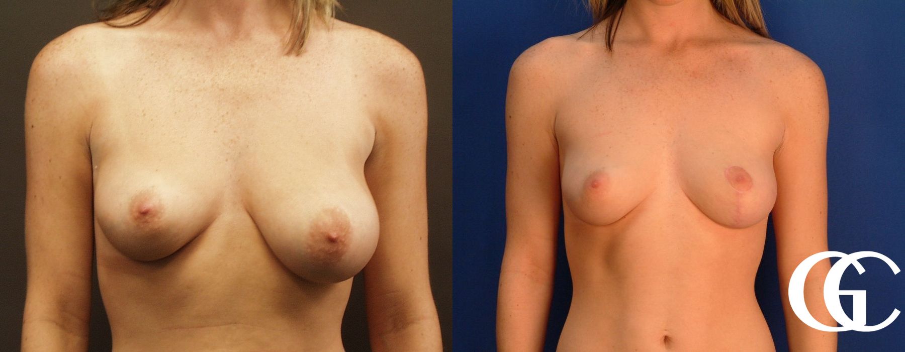 Breast Lift - Thumbnail 2