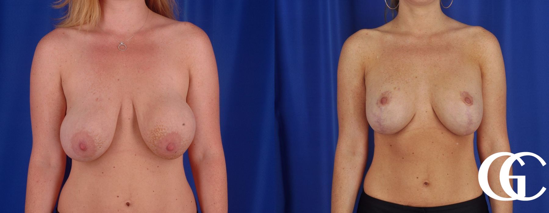 Breast Lift - Thumbnail 2