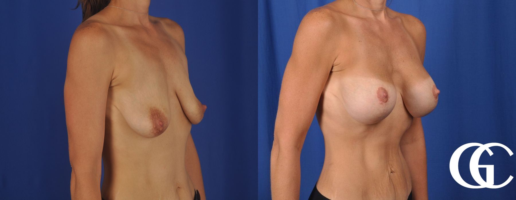 Breast Lift - Thumbnail 2