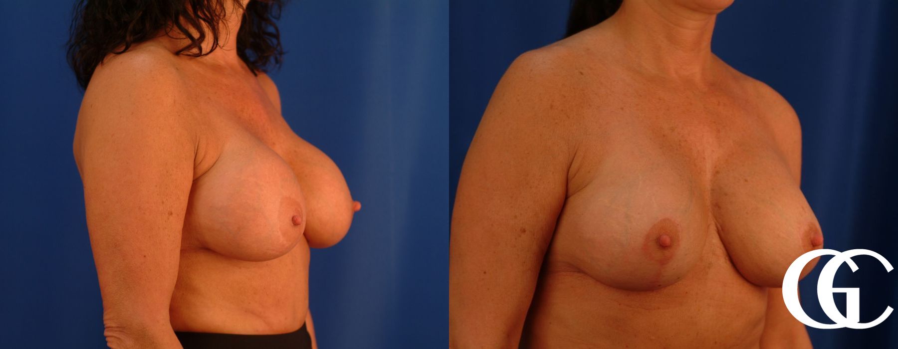 Breast Lift - Thumbnail 4