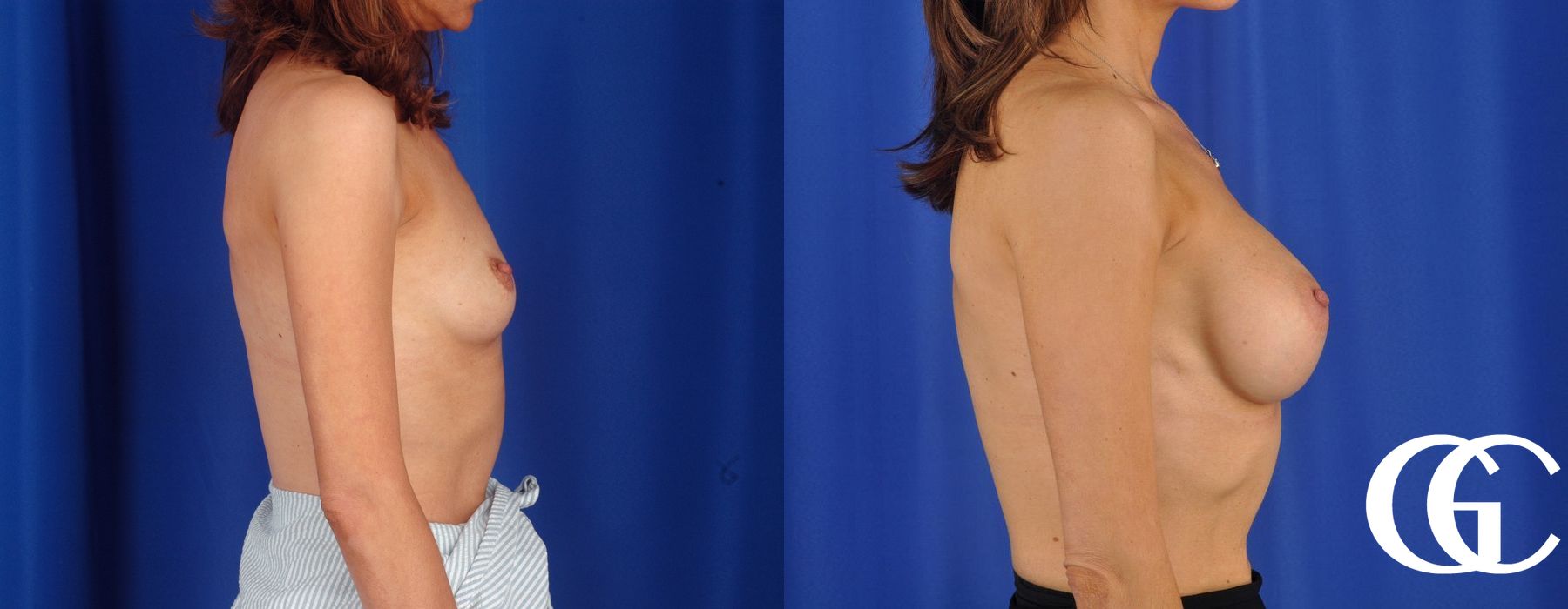 Breast Lift - Thumbnail 3