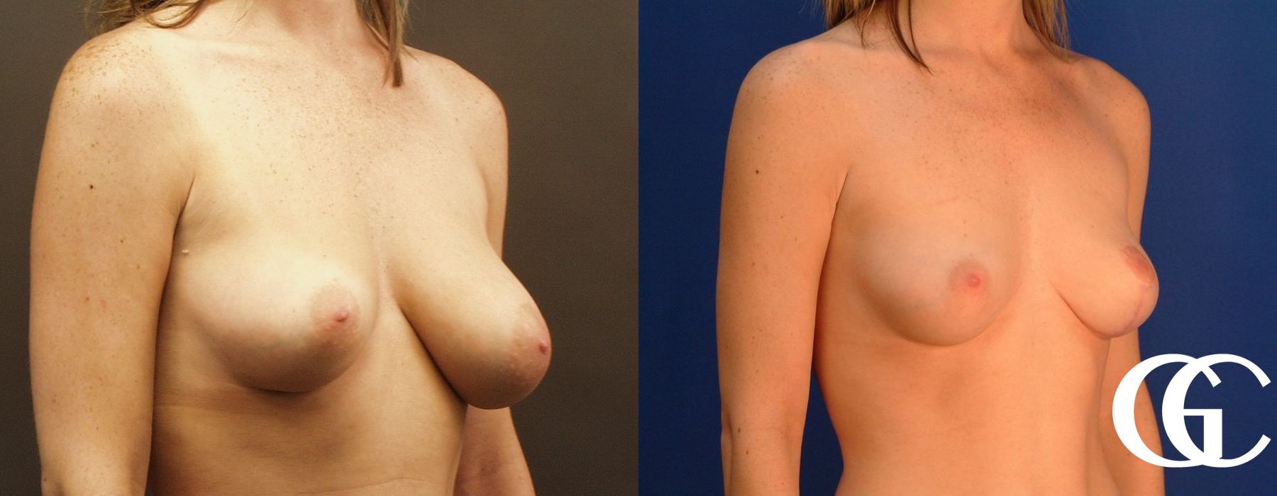 Breast Lift - Thumbnail 3