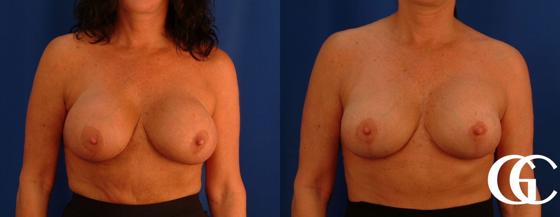 Breast Lift - Thumbnail 2