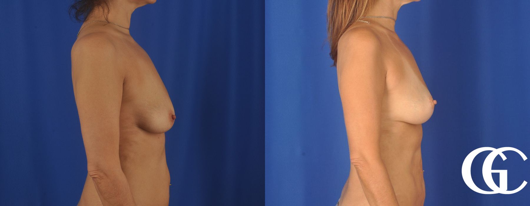 Breast Lift - Case 7277