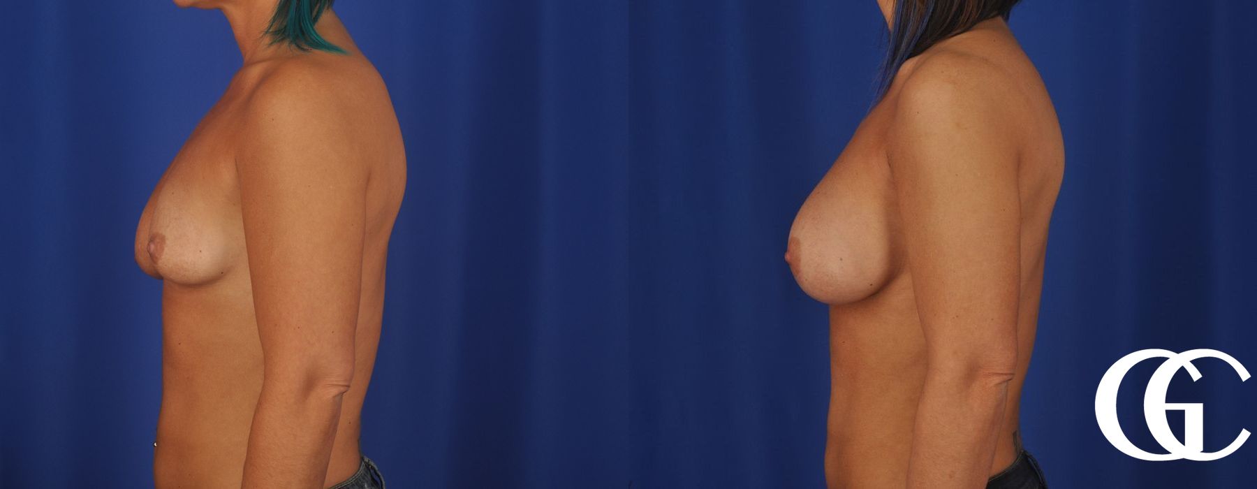 Breast Lift - Thumbnail 4