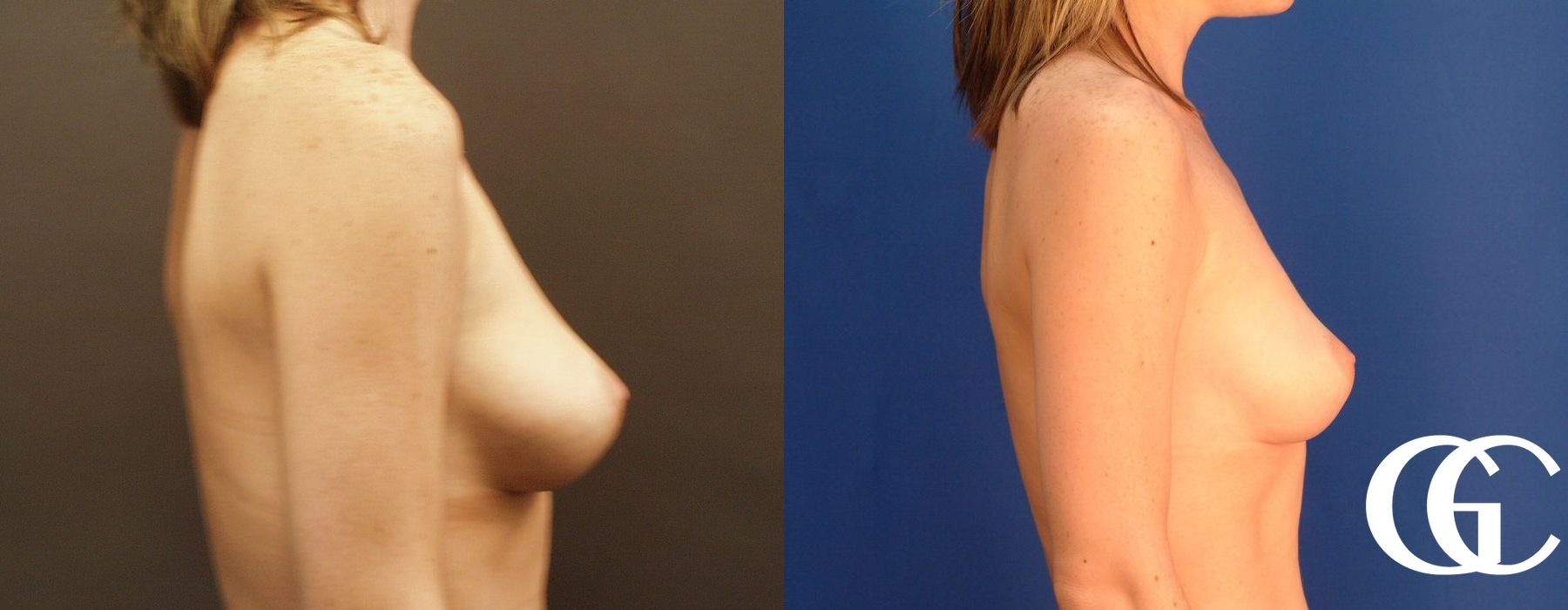 Breast Lift - Case 7254