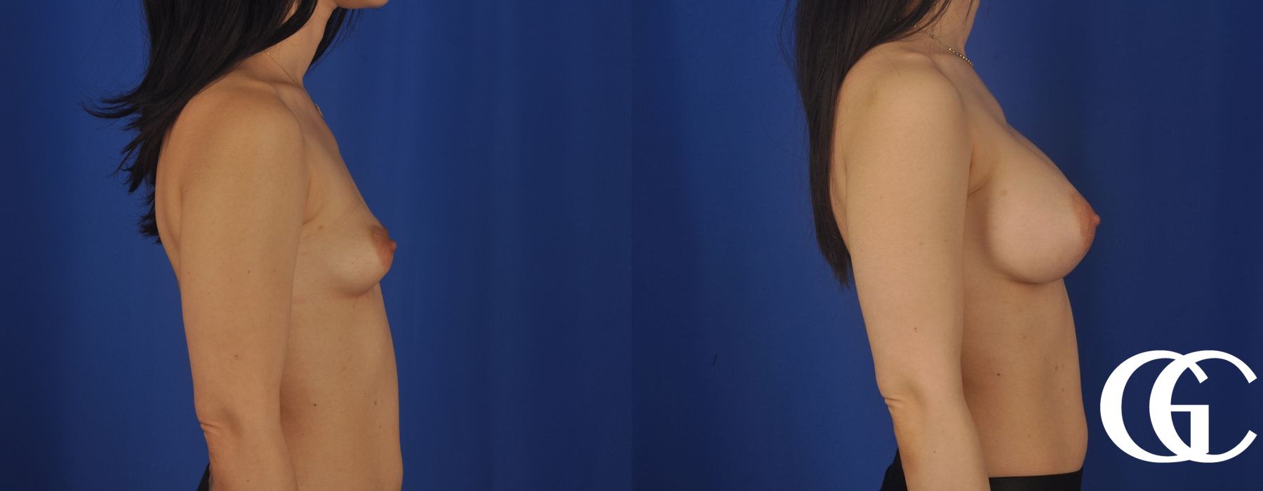 Breast Lift - Thumbnail 3