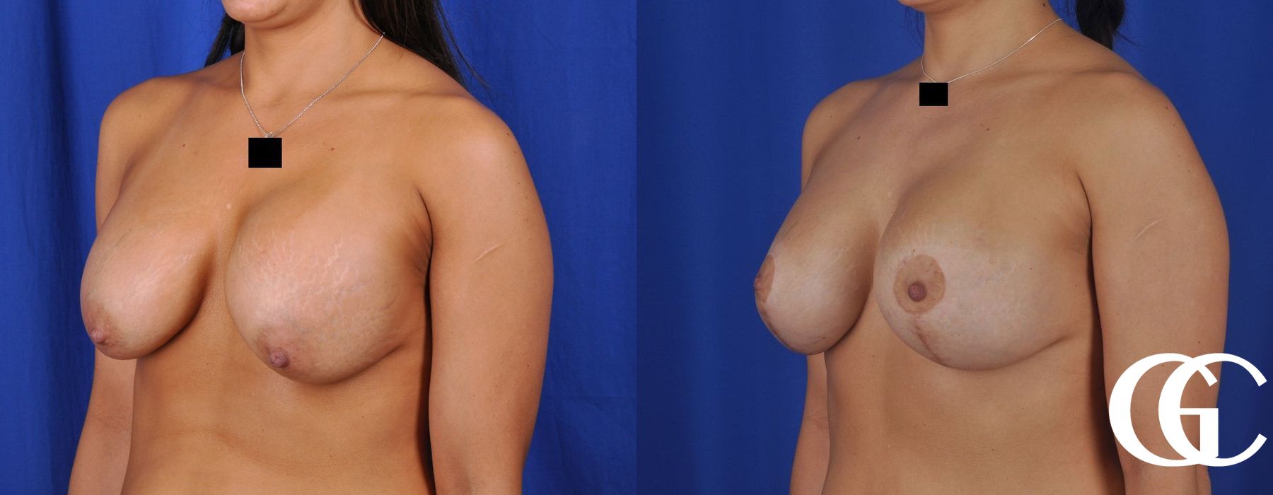 Breast Lift - Case 7241