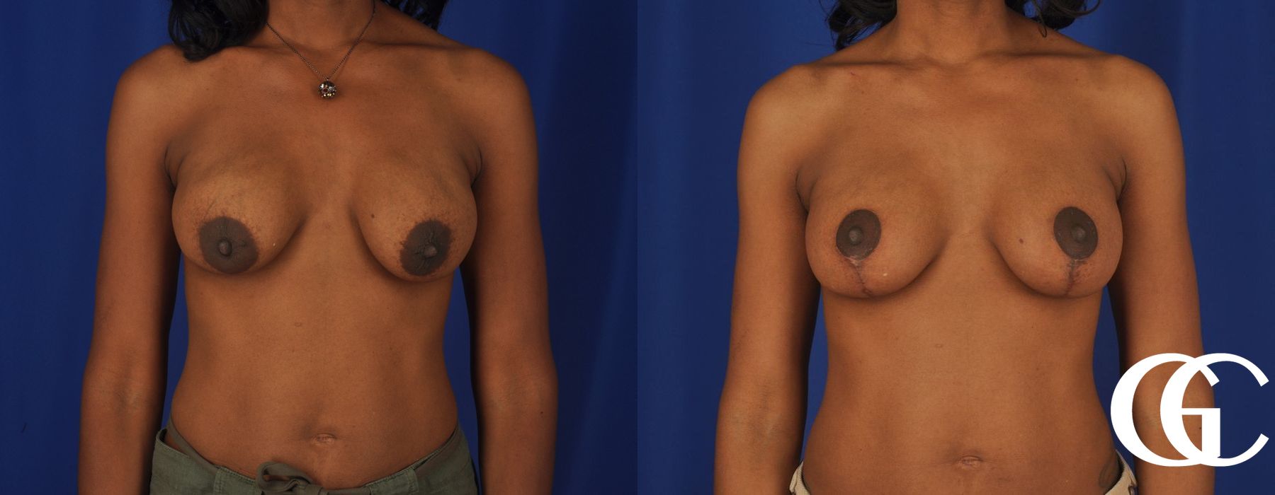 Breast Lift - Case 7250