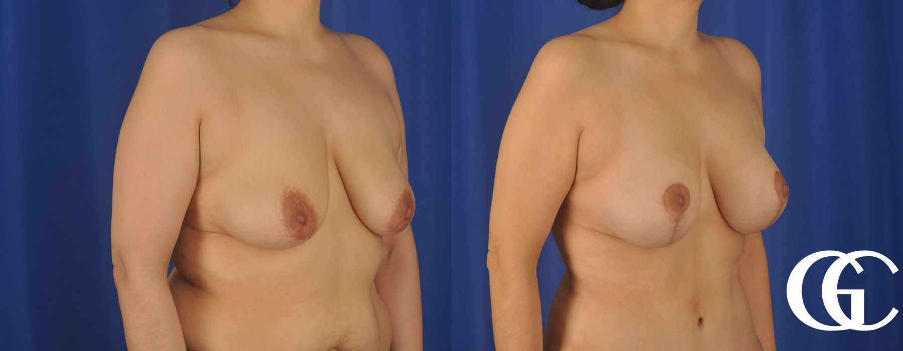 Breast Lift - Thumbnail 2