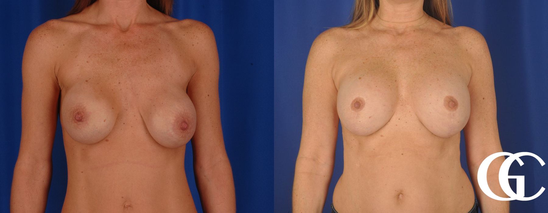 Breast Lift - Case 7286