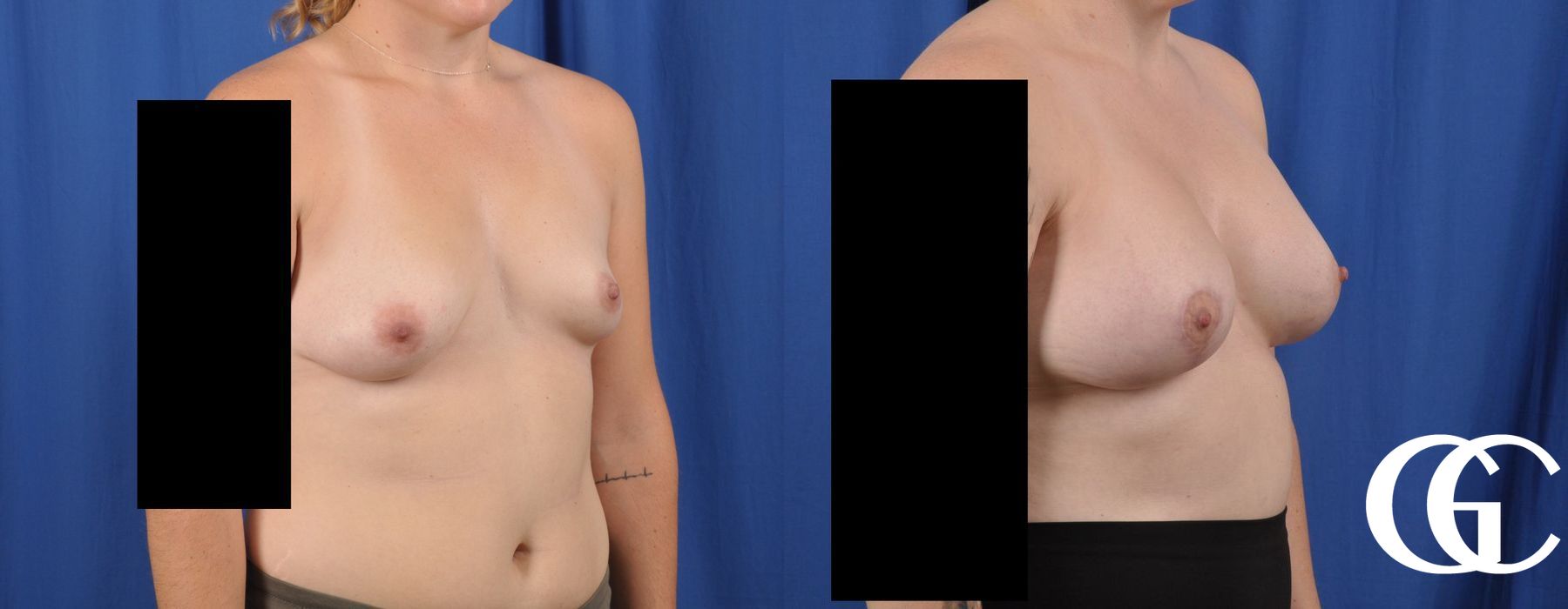 Breast Lift - Thumbnail 2