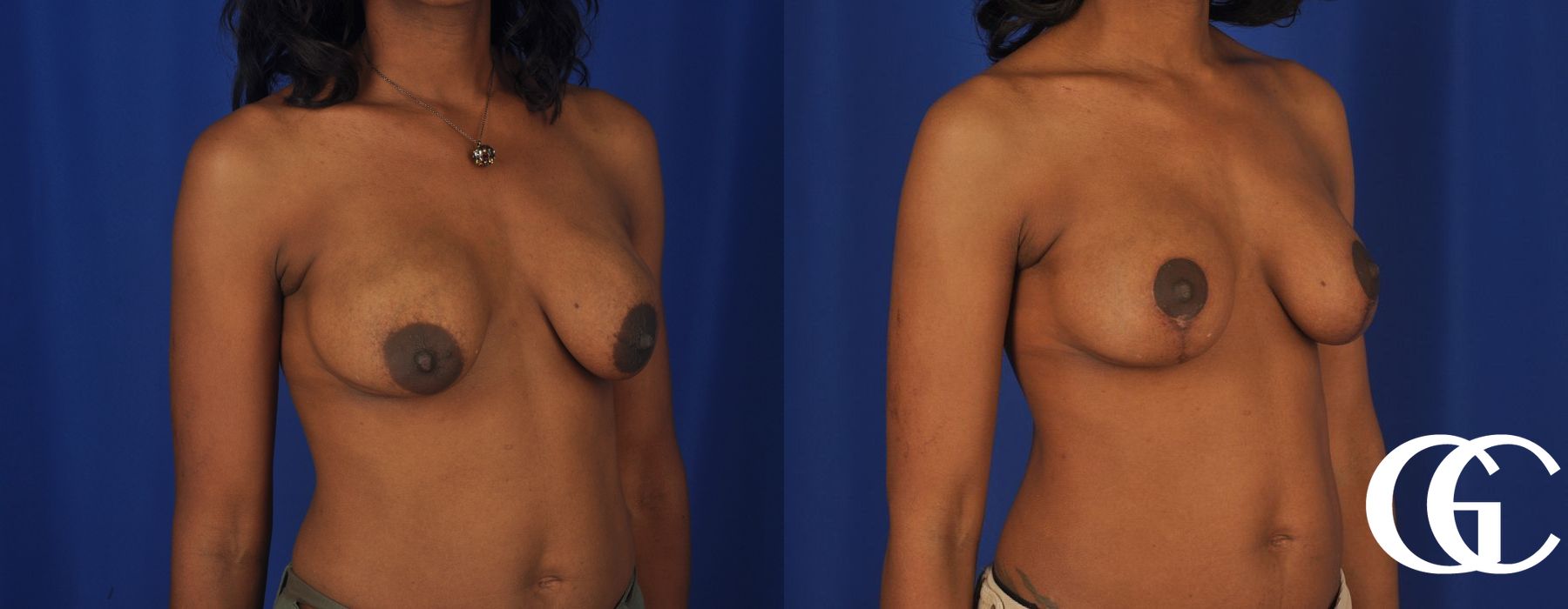 Breast Lift - Thumbnail 2