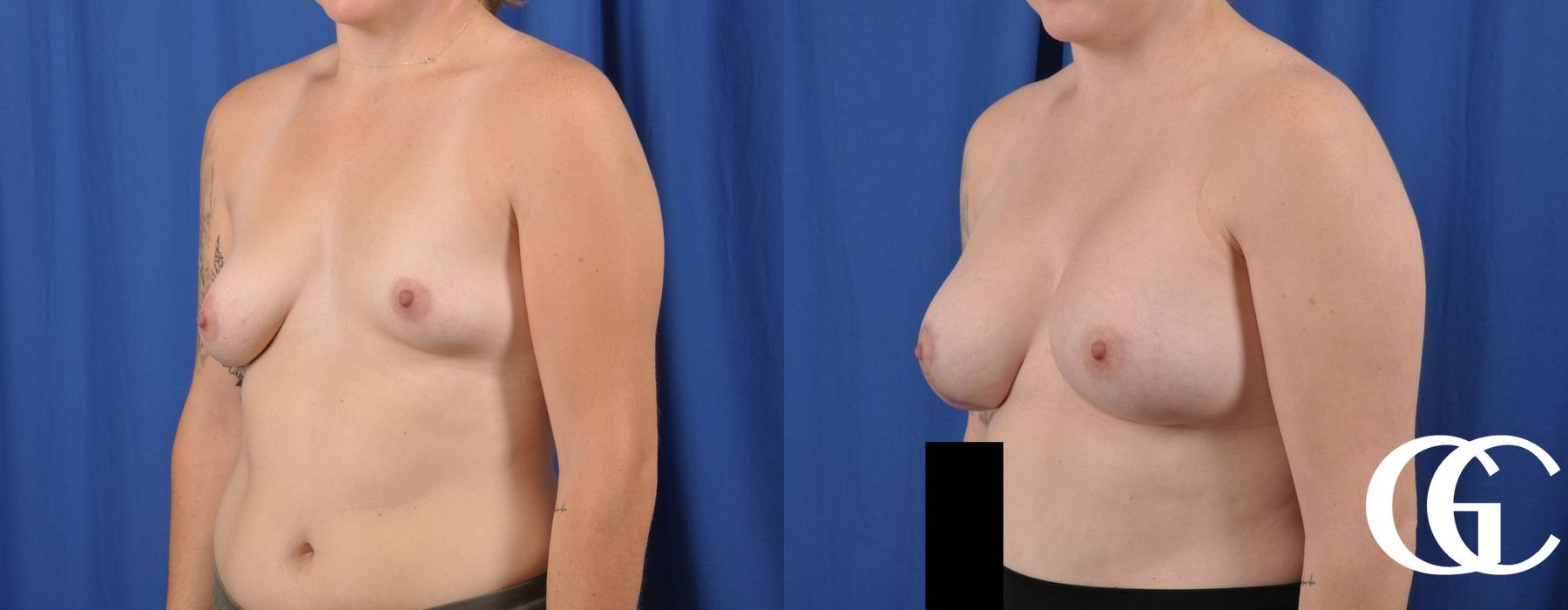 Breast Lift - Thumbnail 4