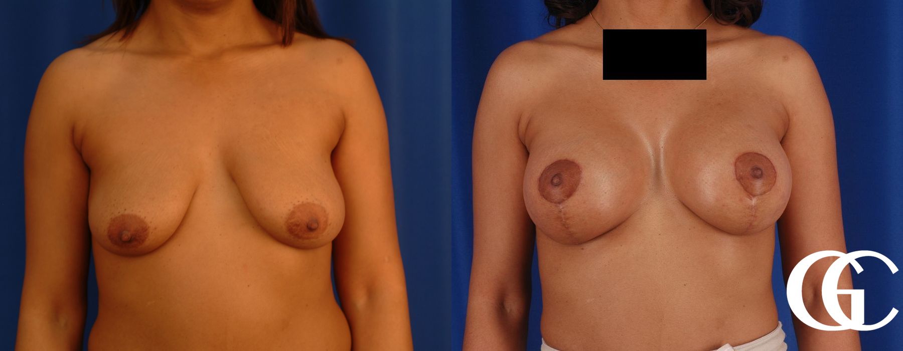 Breast Lift - Case 7294