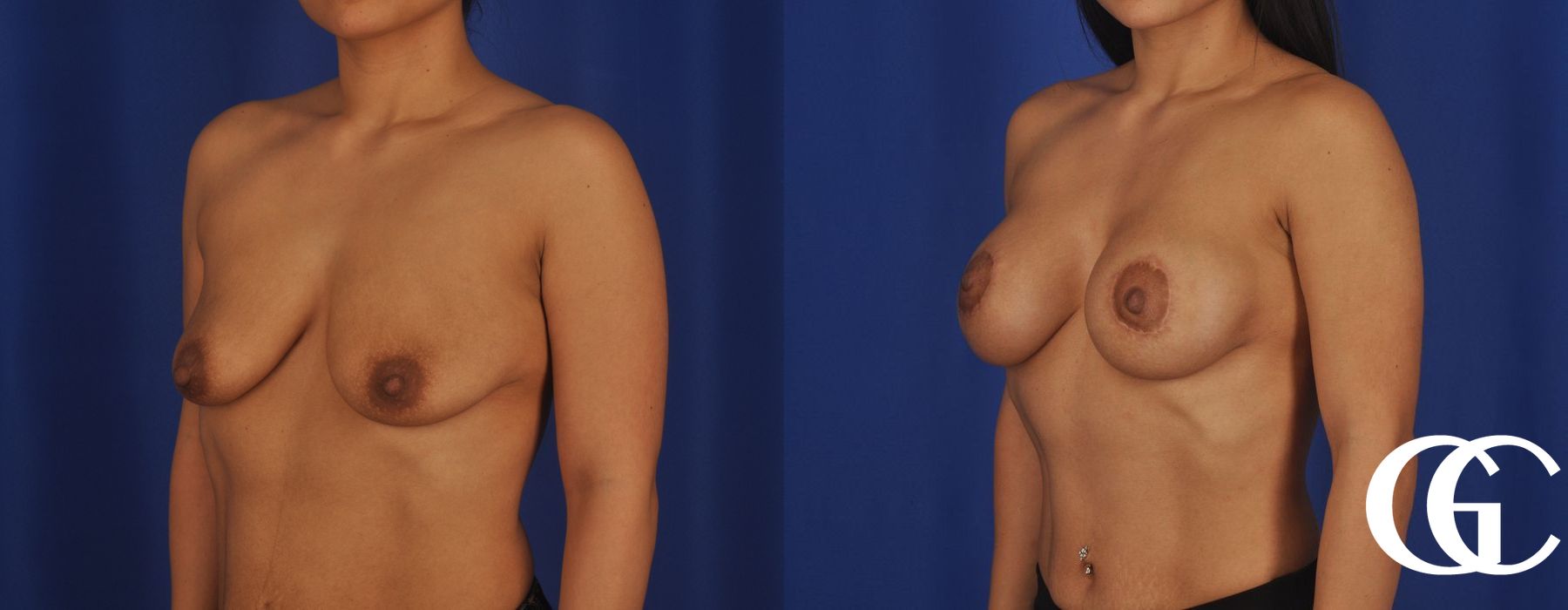 Breast Lift - Thumbnail 4