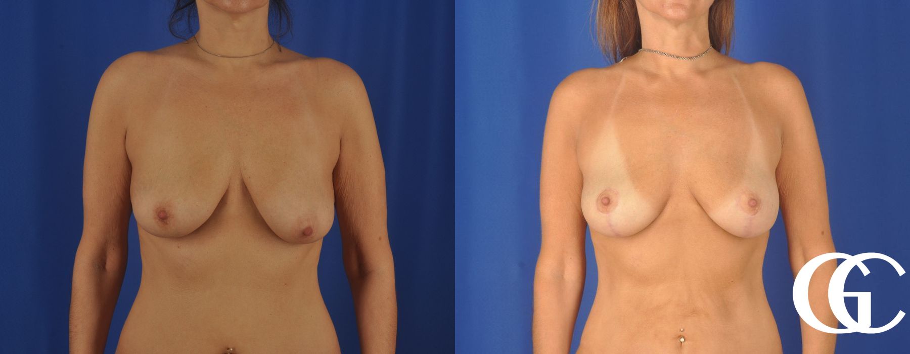 Breast Lift - Thumbnail 2