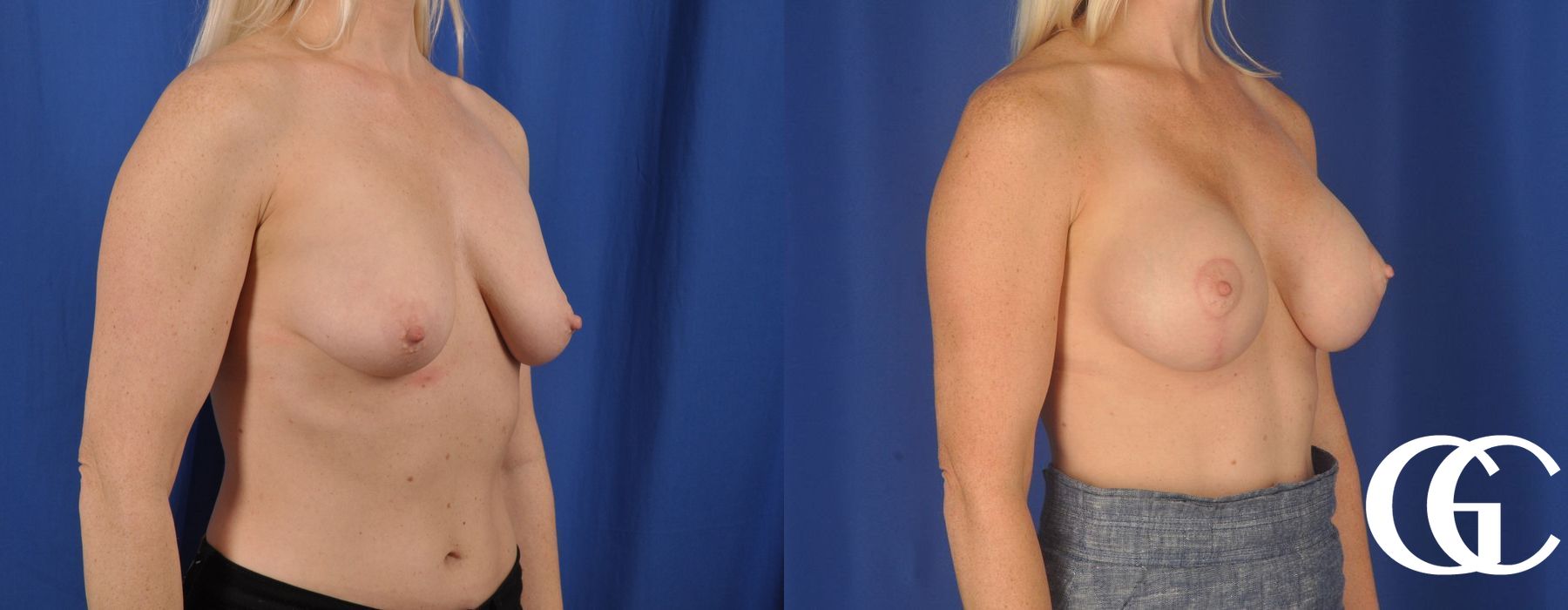 Breast Lift - Thumbnail 4