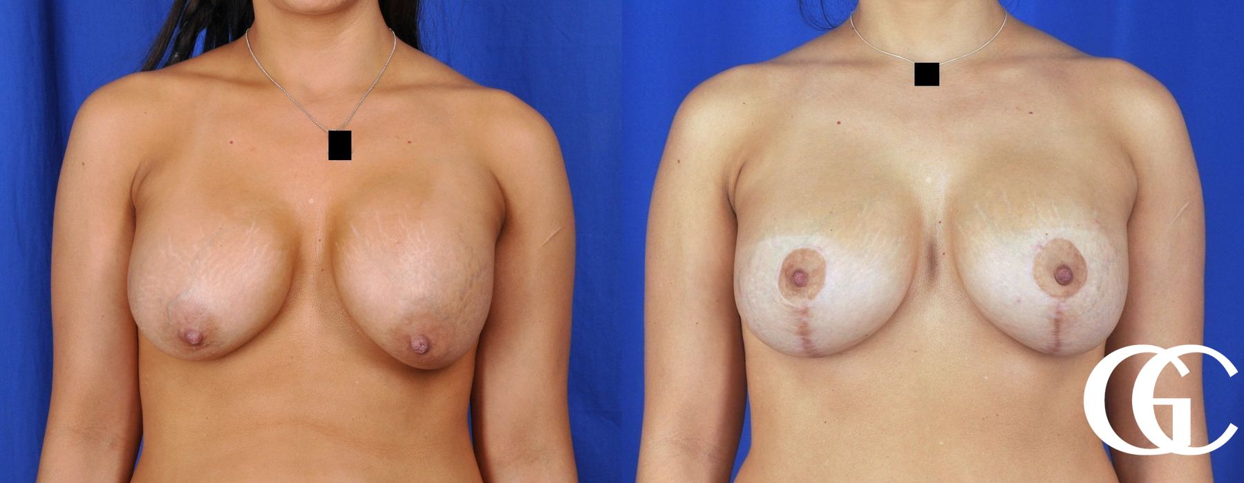 Breast Lift - Thumbnail 2