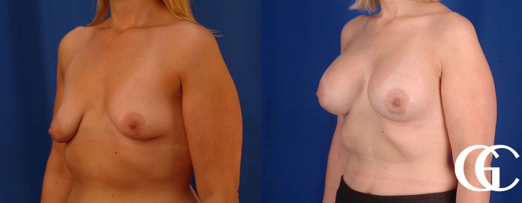 Breast Lift - Thumbnail 4