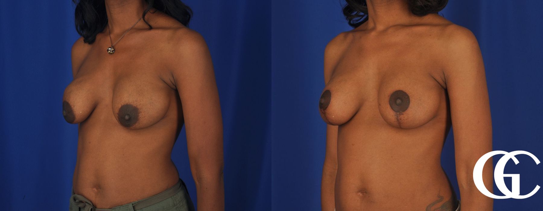 Breast Lift - Thumbnail 4