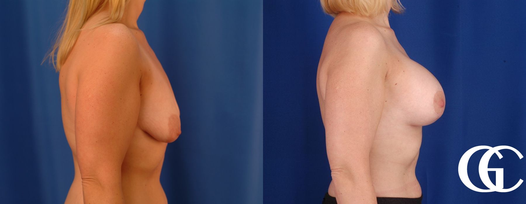 Breast Lift - Case 7290
