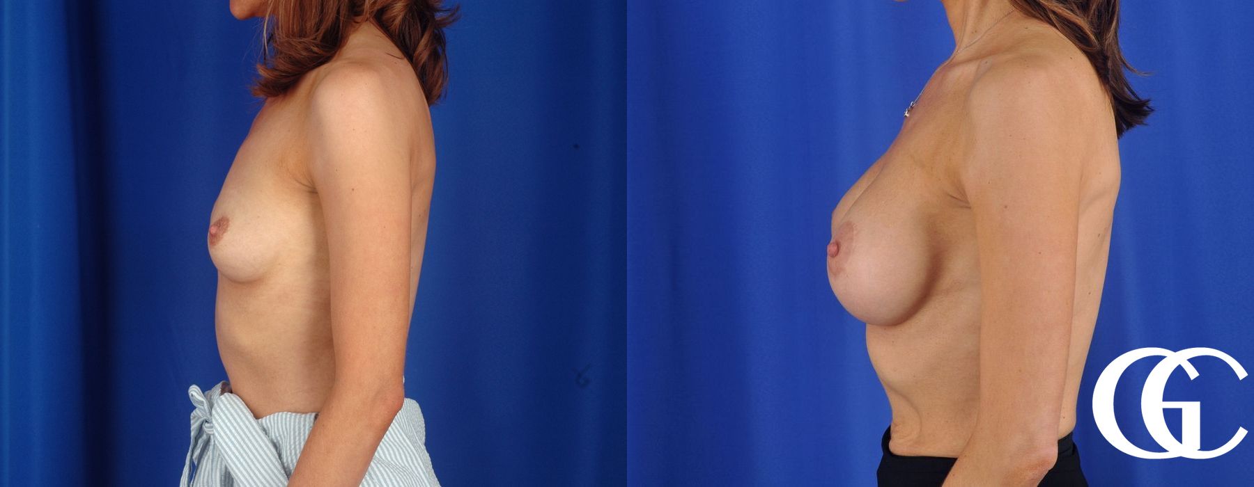 Breast Lift - Thumbnail 5