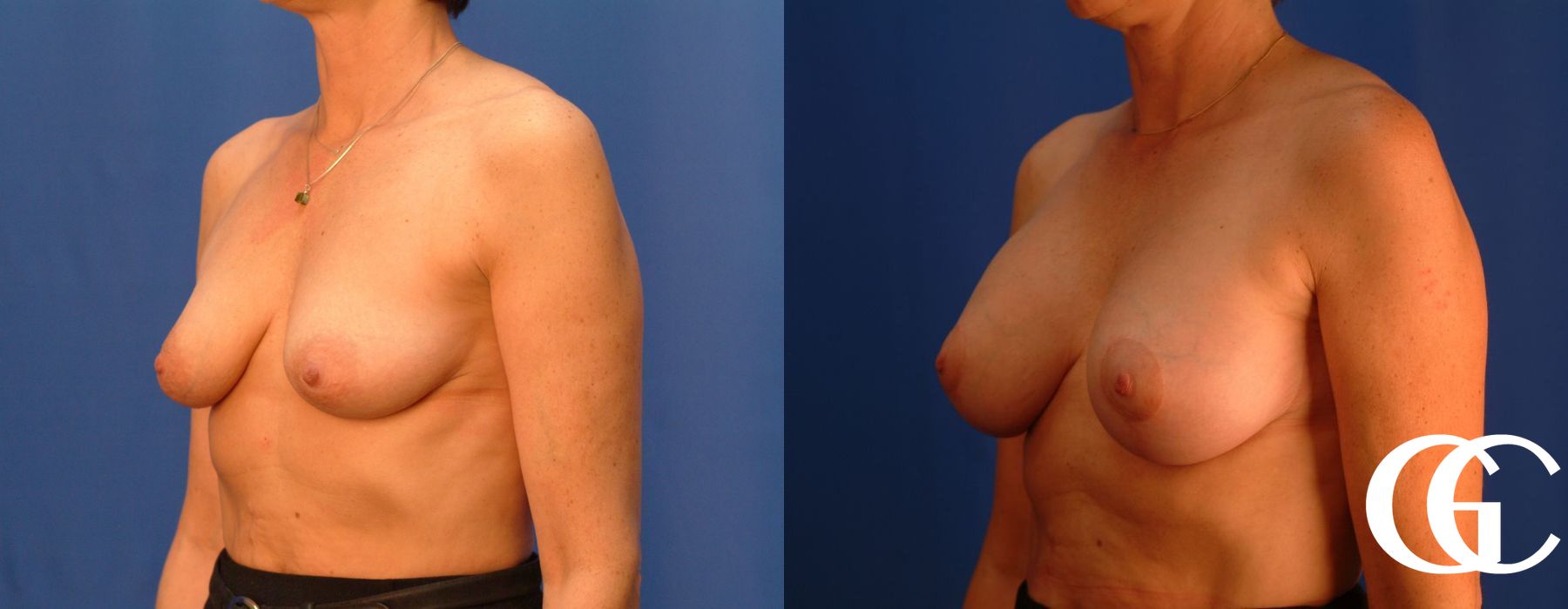 Breast Lift - Thumbnail 4