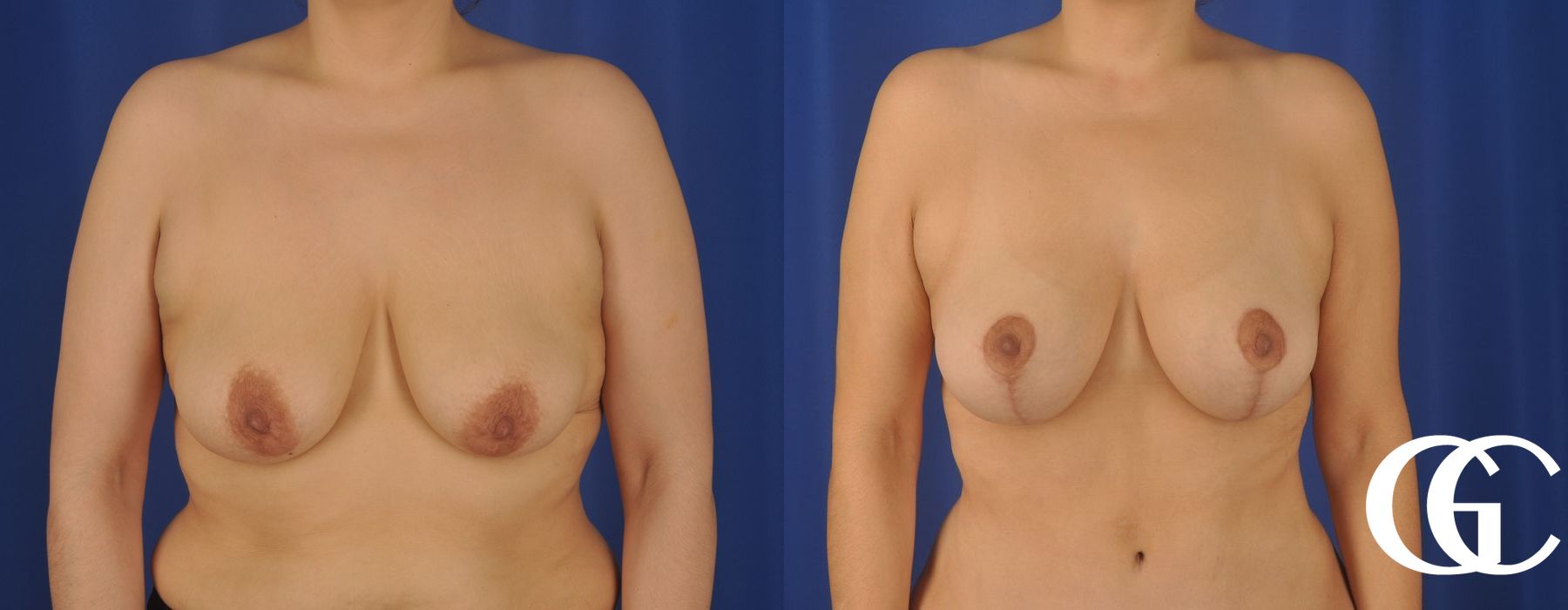Breast Lift - Case 7274