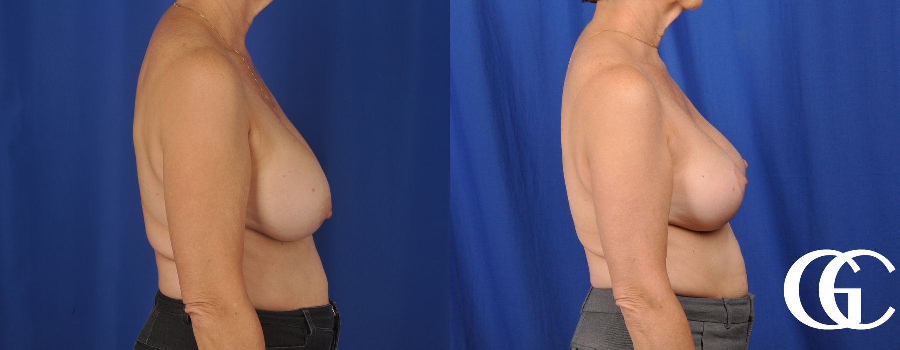 Breast Lift - Case 7242