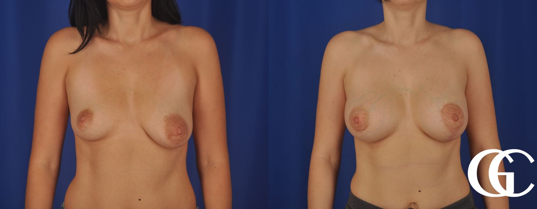 Breast Lift - Thumbnail 2
