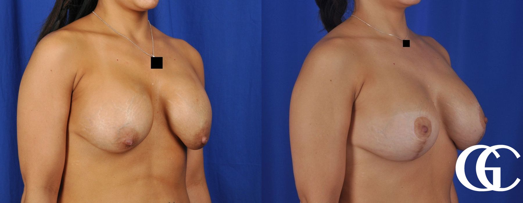 Breast Lift - Thumbnail 4