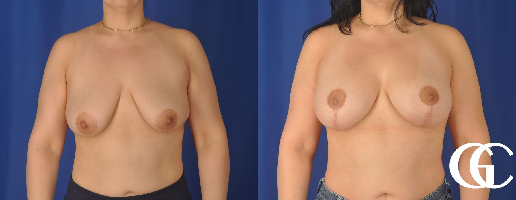 Breast Lift - Thumbnail 2