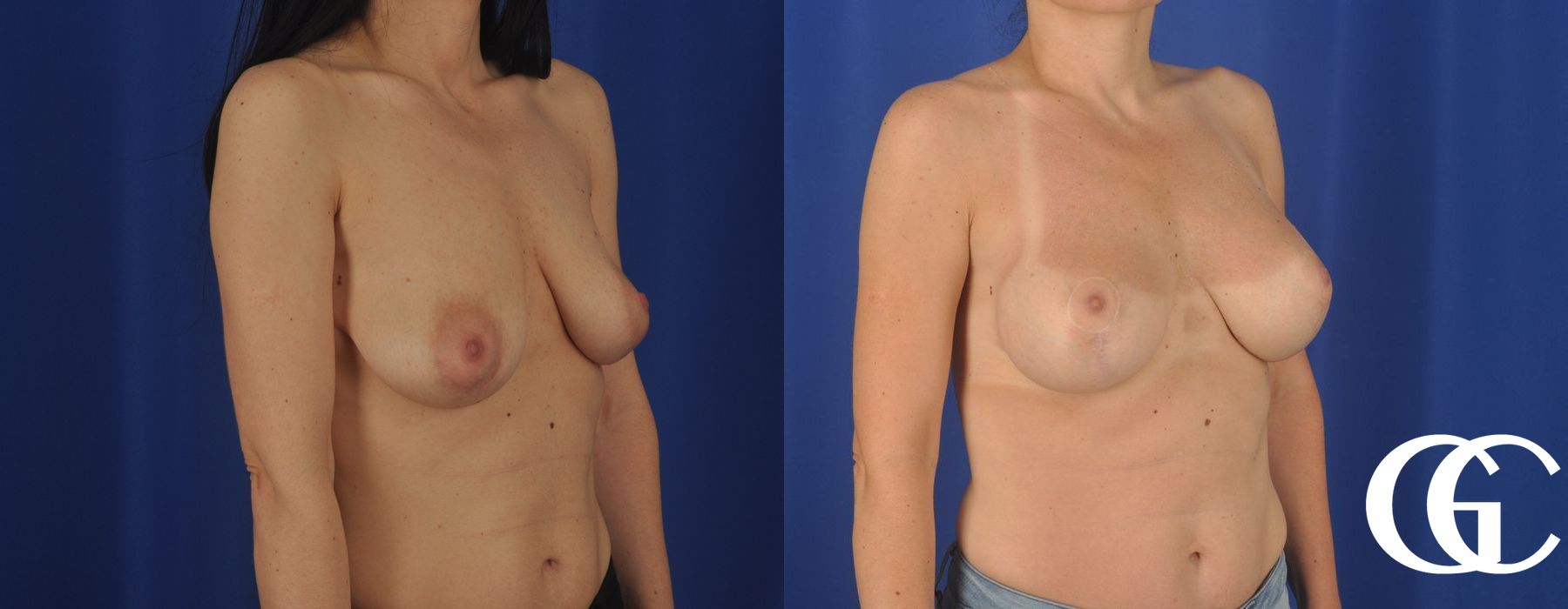 Breast Lift - Thumbnail 3
