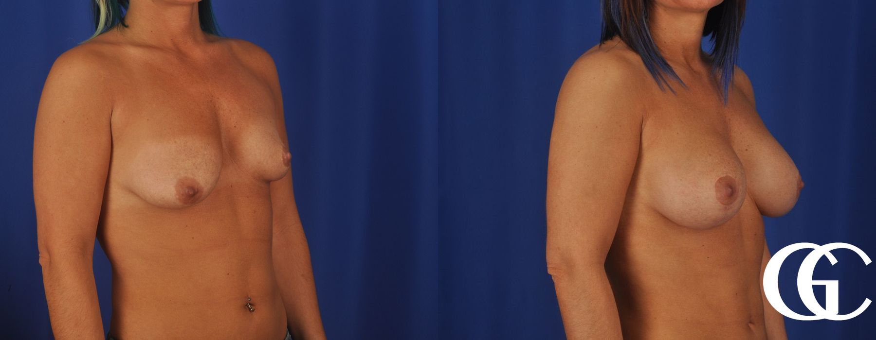 Breast Lift - Case 7249