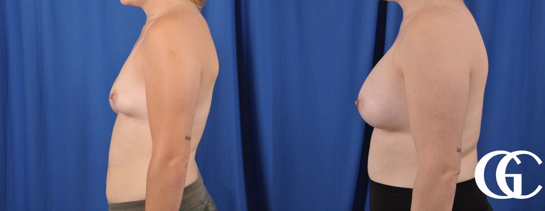 Breast Lift - Thumbnail 3