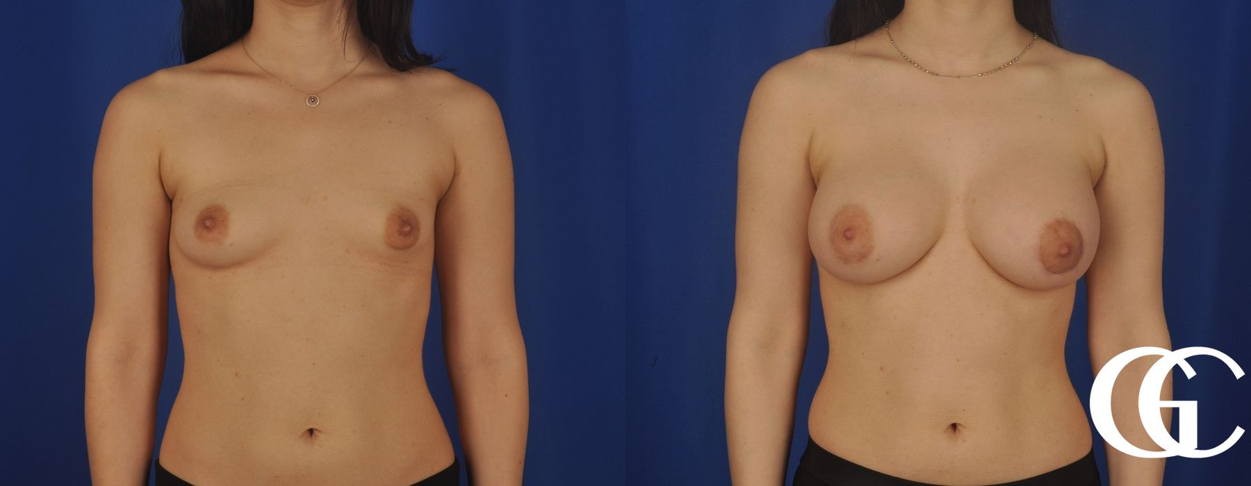 Breast Lift - Case 7265