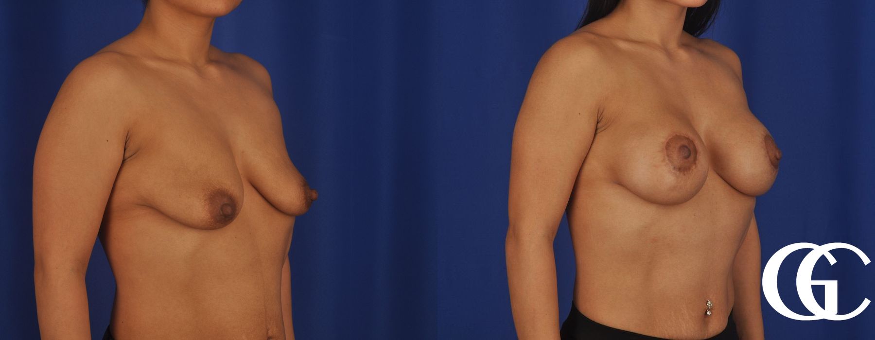 Breast Lift - Thumbnail 3