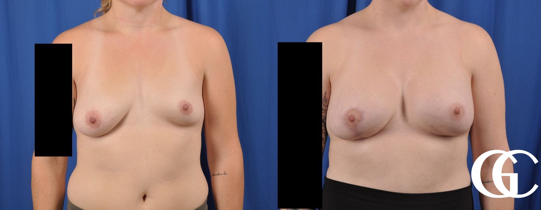Breast Lift - Case 7293