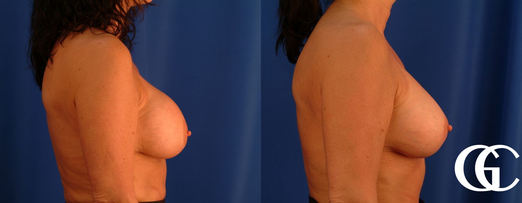 Breast Lift - Thumbnail 3