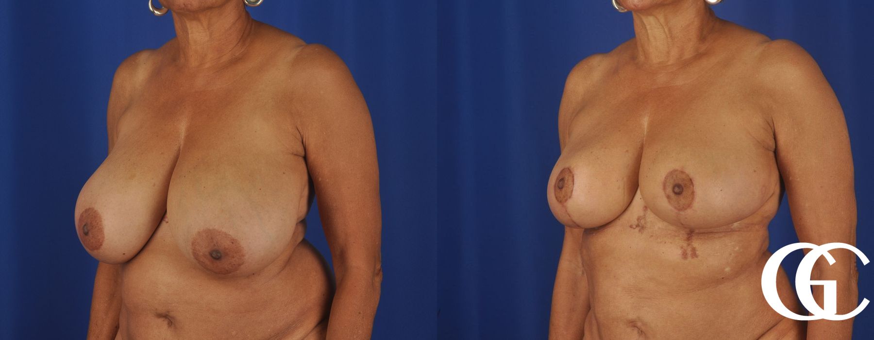Breast Reduction - Thumbnail 4