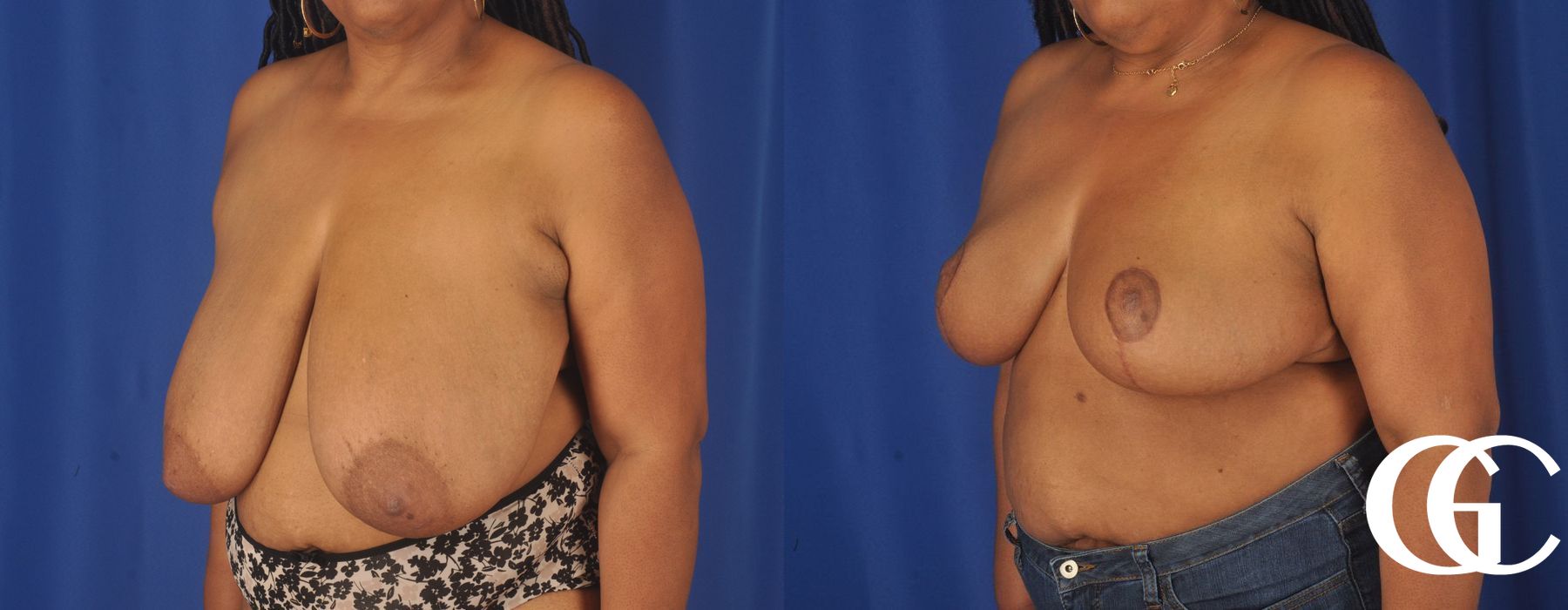 Breast Reduction - Thumbnail 2