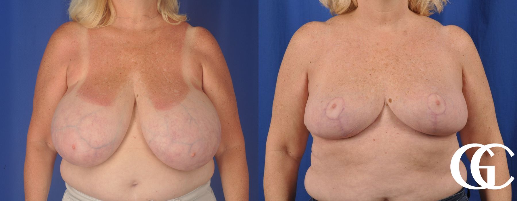 Breast Reduction - Thumbnail 2