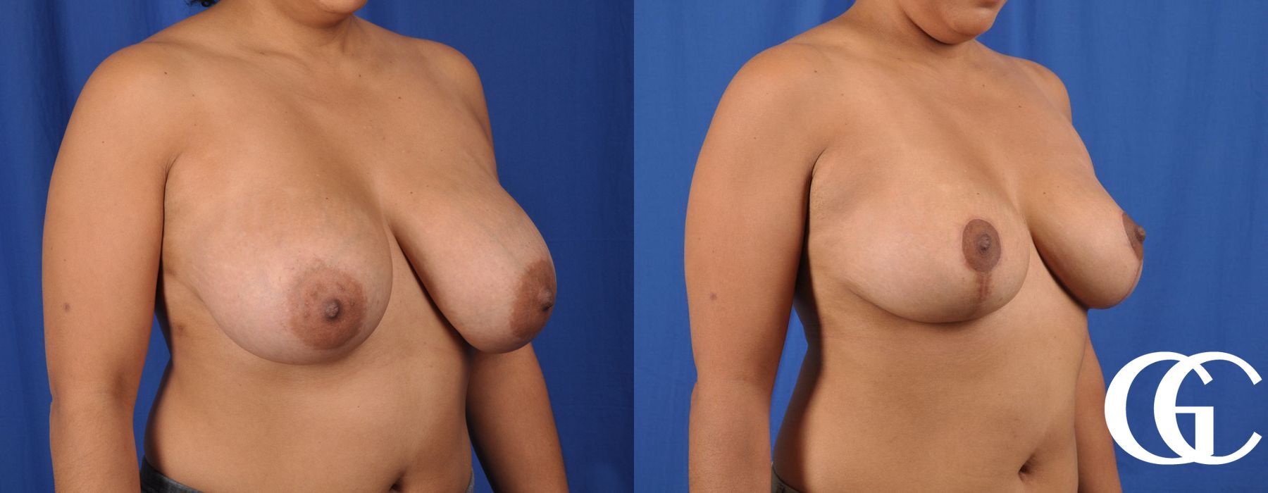 Breast Reduction - Thumbnail 4