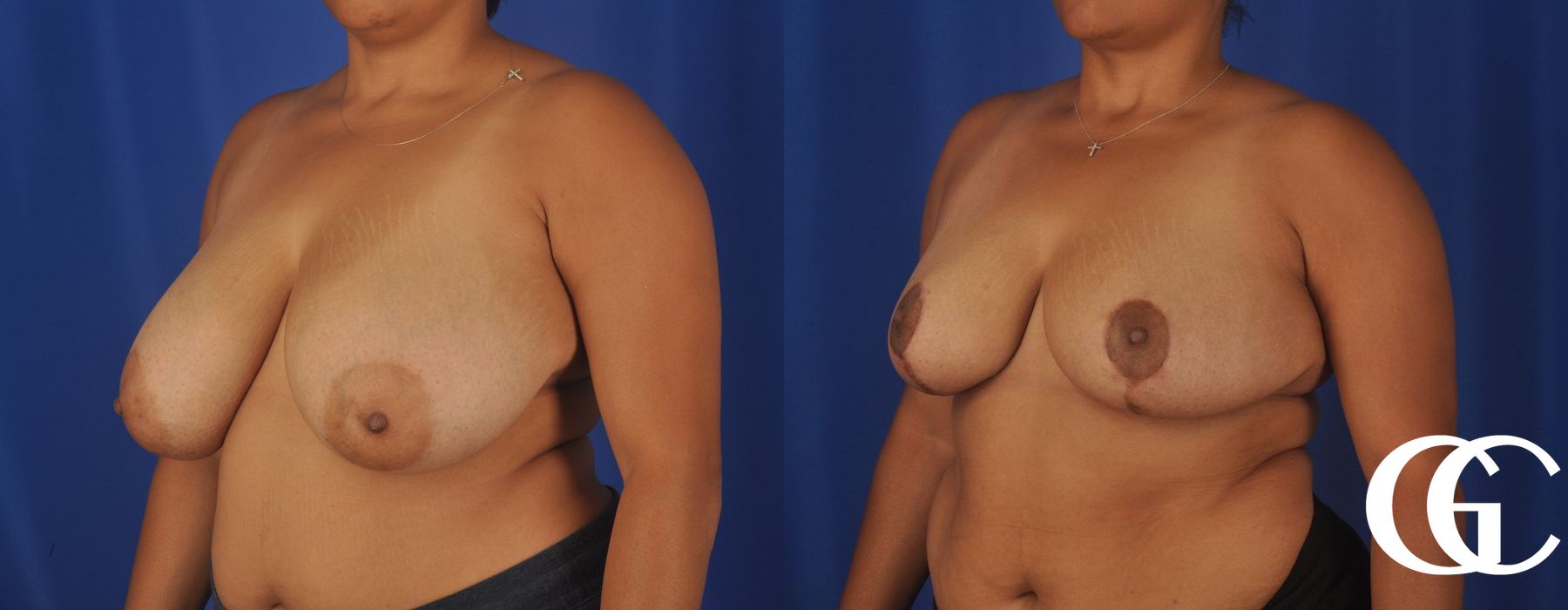Breast Reduction - Case 7318