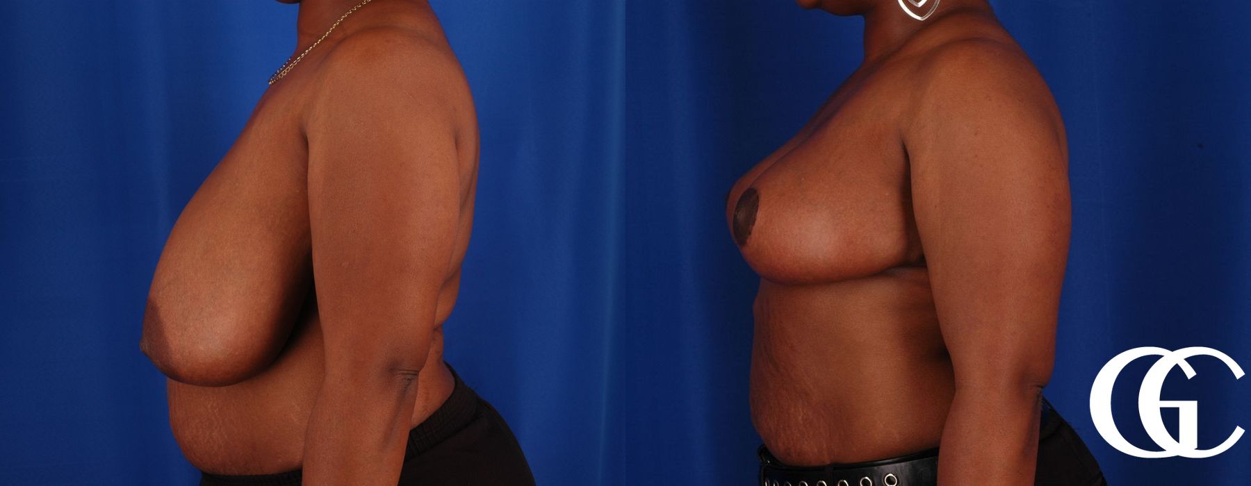 Breast Reduction - Thumbnail 5