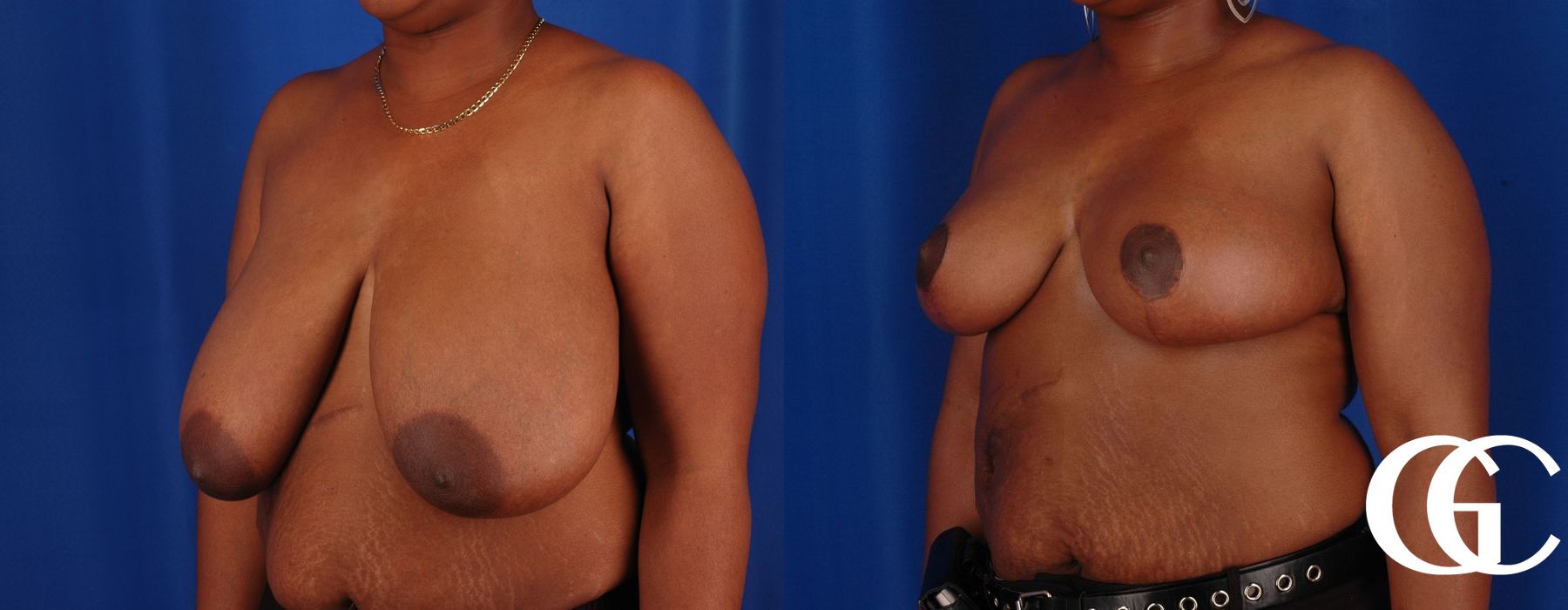 Breast Reduction - Case 7302